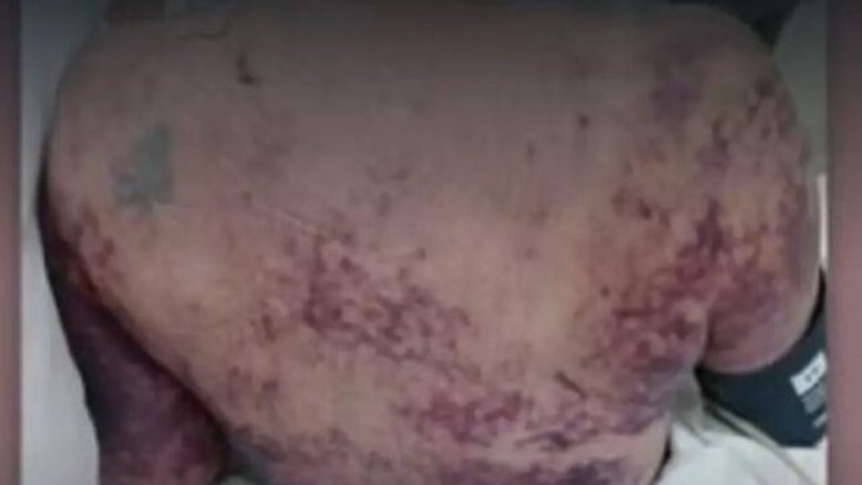 Mulher morre após infecção rara causada por mordida de cachorro