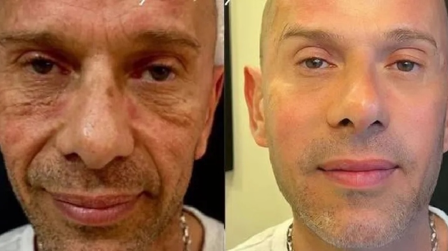 Antes e depois: veja os famosos que fizeram harmonização facial - ISTOÉ  Independente