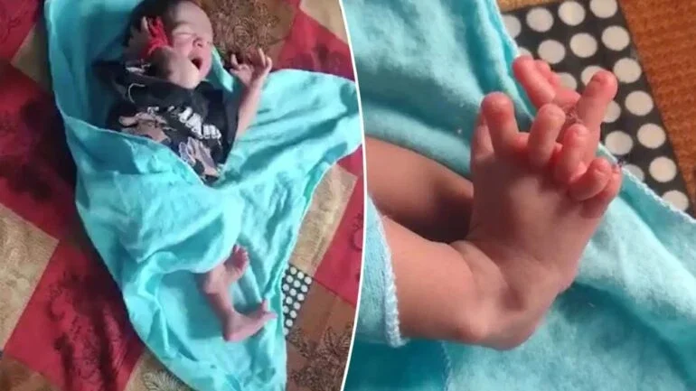 Bebê nasce com 26 dedos e é considerada a “reencarnação da deusa hindu”