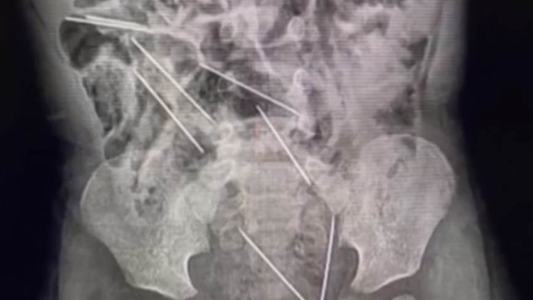 Criança peruana é submetida a cirurgia após engolir oito agulhas