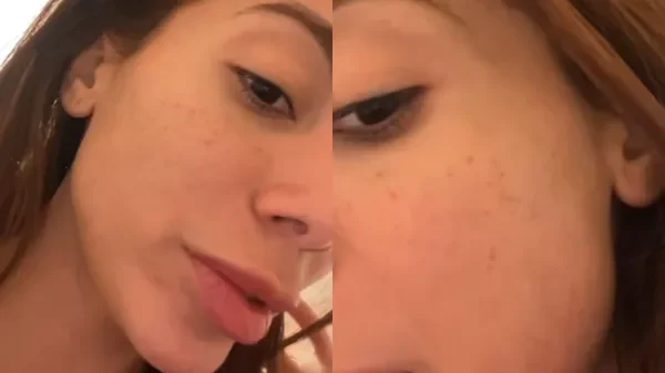 Anitta fala sobre manchas no rosto após procedimento com laser