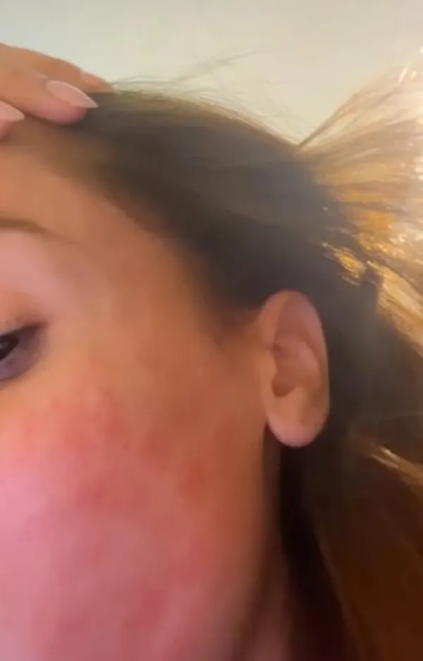 Anitta explica manchas vermelhas no rosto após procedimento com laser: 'Depois que sai fica dos sonhos' 2 Anitta mostra rosto vermelho após procedimento com laser
