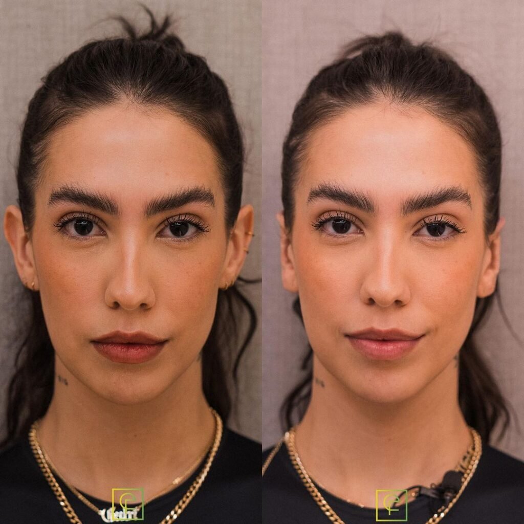 Influencer Gabi Brandt realiza procedimento estético nas orelhas; veja antes e depois 2 Gabi Brandt realizou procedimento estético nas orelhas