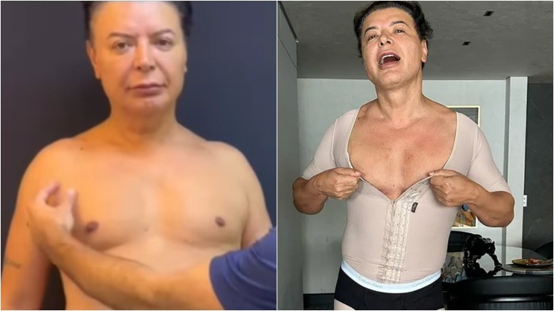 David Brazil exibe corpo um mês após lipoaspiração; confira o antes e depois
