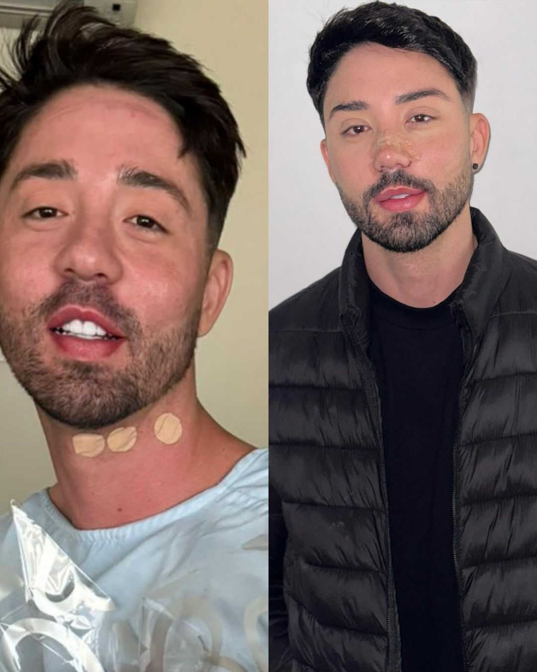 Rico Melquiades antes e depois da cirurgia no rosto