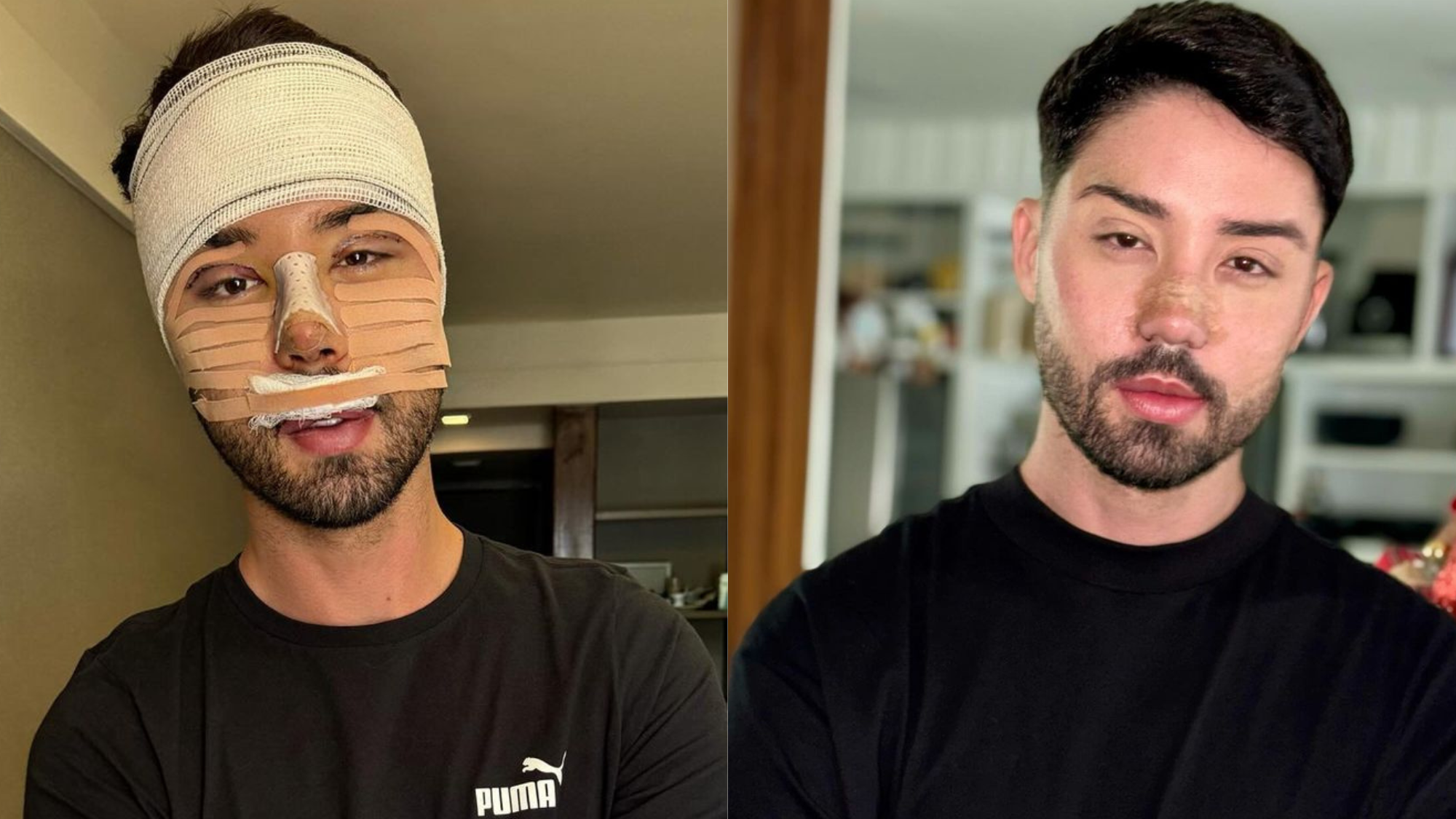 Rico Melquiades mostra antes e depois de cirurgia no rosto