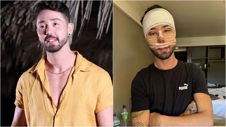 Rico Melquíades desabafa após cirurgia estética no rosto: 'Não aguentava mais me chamarem de feio’
