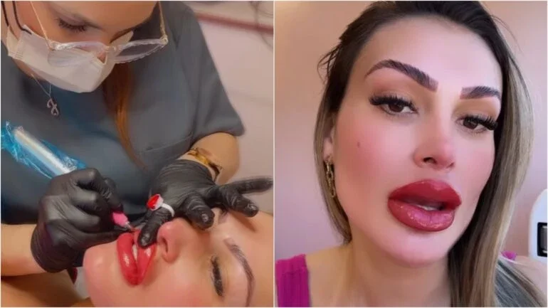 Andressa Urach apresenta resultado de procedimento estético na boca: ‘Efeito batom’