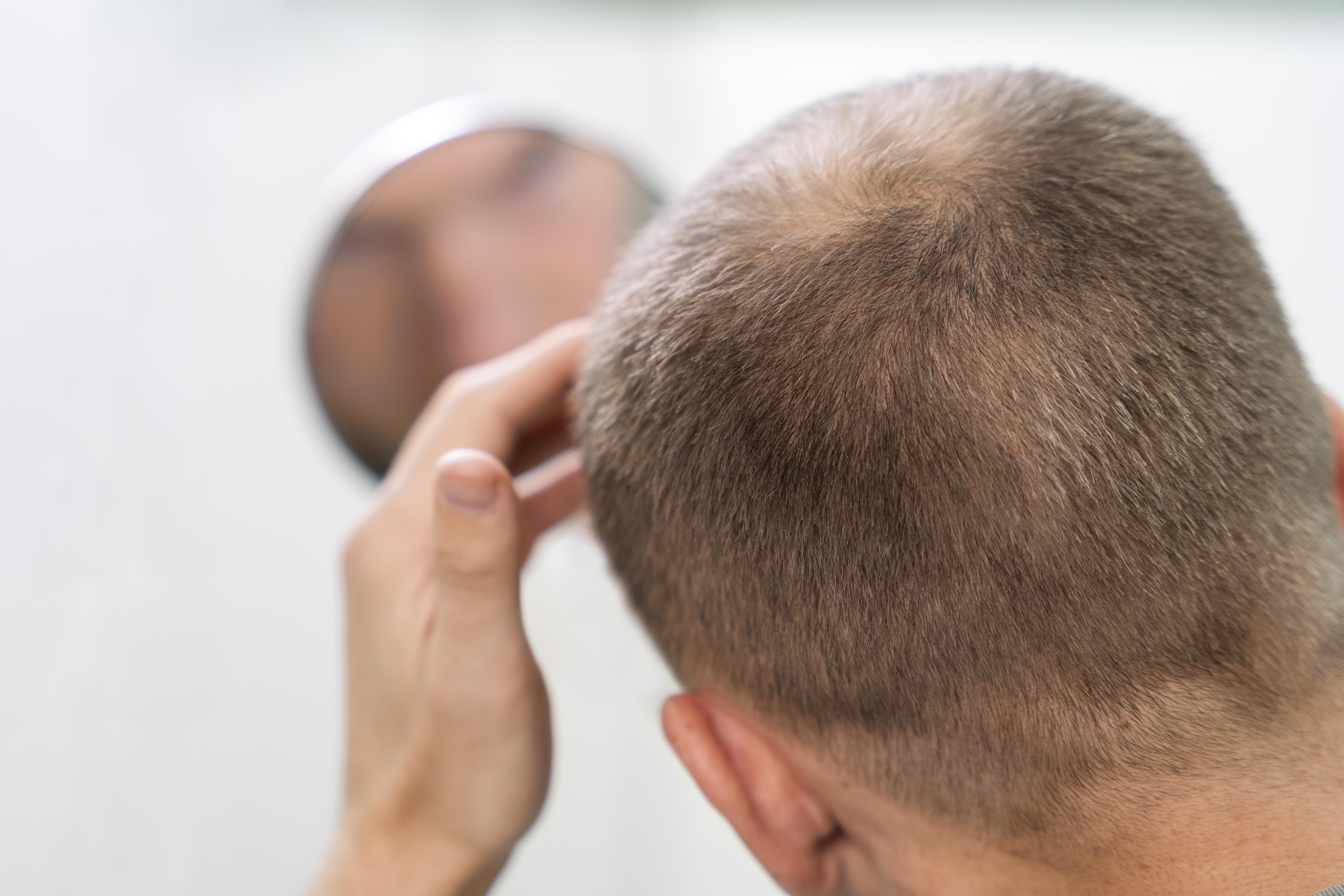 Alopecia areata é uma patologia na qual ocorre uma inflamação ao redor da raiz dos folículos capilares, levando à queda dos fios