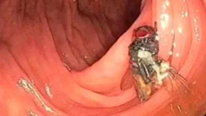 EUA: mosca que vivia em intestino de paciente surpreende médicos em colonoscopia