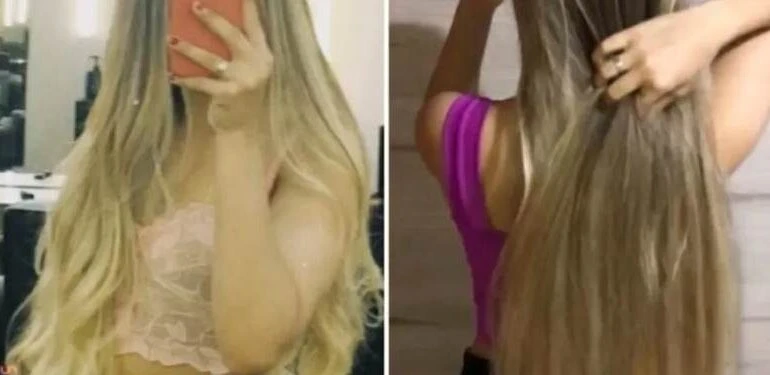 DF: adolescente é escalpelada em corrida de kart e perde 80% do couro cabeludo