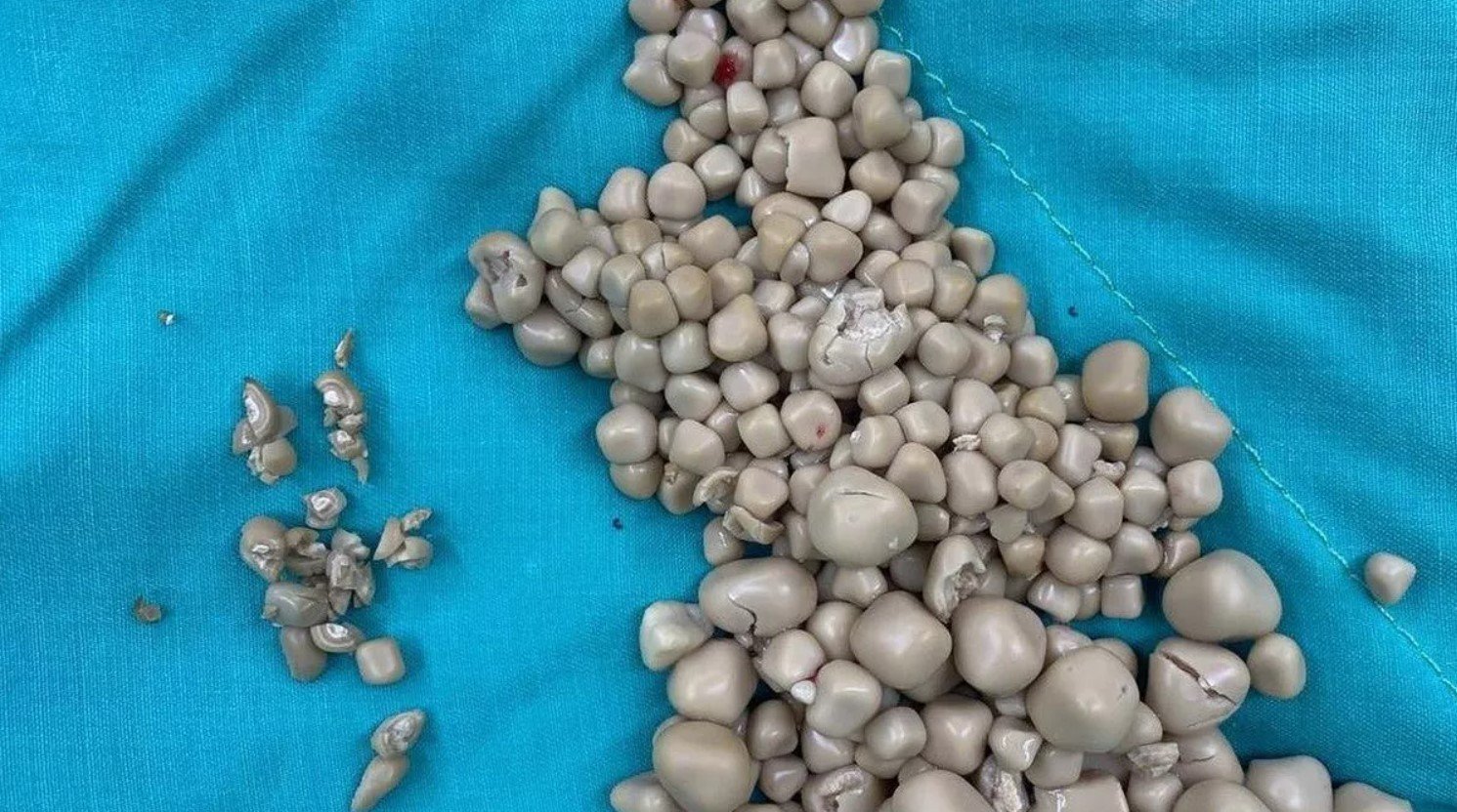 Médicos retiram 300 pedras do rim de taiwanesa que não tomava água