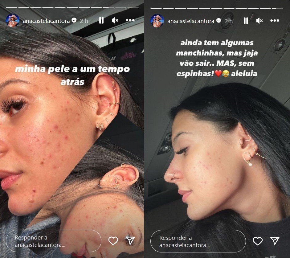 Ana Castela apresenta antes e depois de procedimento estético e comemora: ‘Sem espinhas!’ 2 Ana Castela apresenta antes e depois de procedimento estético e comemora: ‘Sem espinhas!’