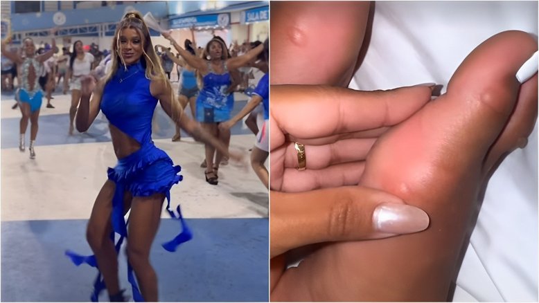 Brunna Gonçalves cai no samba e ‘ganha’ bolhas no pé: 'Saldo da noite'
