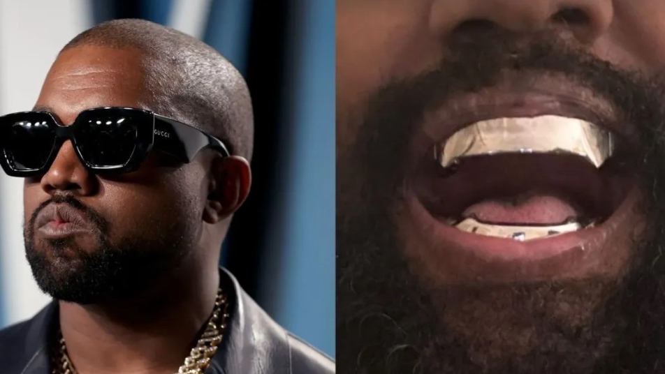 'Contra indicação', diz dentista sobre Kanye West remover dentes e cobrir com prótese de titânio