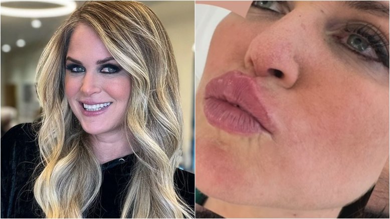 Susana Werner faz procedimento estético e impressiona com transformação facial