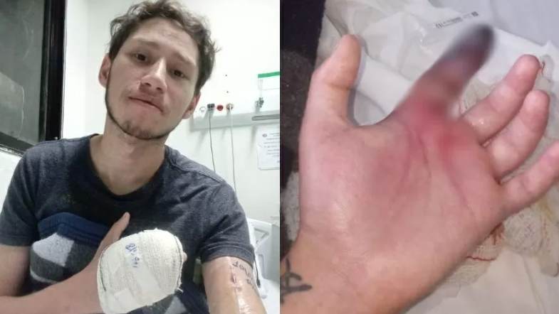 SP: garçom acusa hospital de negligência por amputar dedos após picada de aranha
