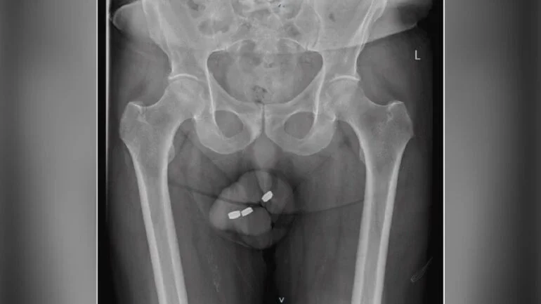 Divulgação/Urology Case Report