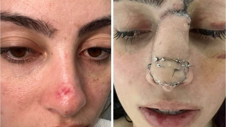 Jovem descobre câncer após tirar 'sinal' do nariz