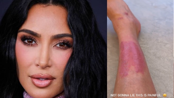 Kim Kardashian choca ao mostrar lesão na perna causada por psoríase; conheça doença autoimune
