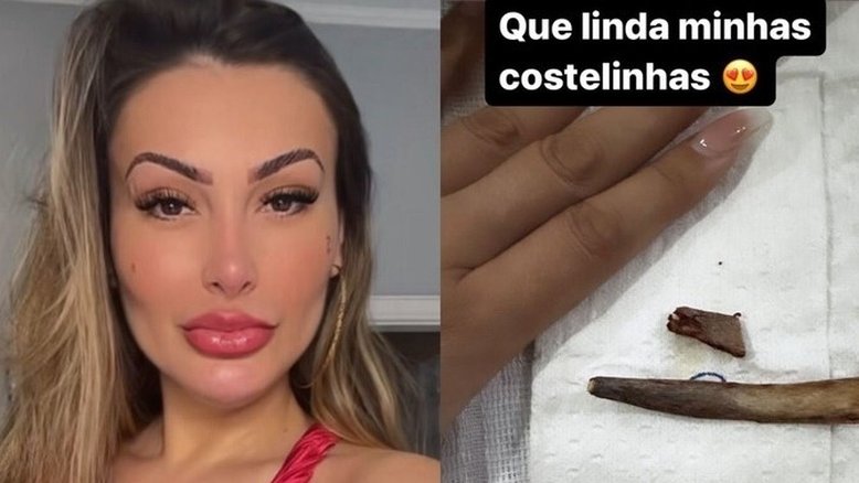 Andressa Urach não é a única? Outra famosa também pode ter retirado as costelas; saiba quem