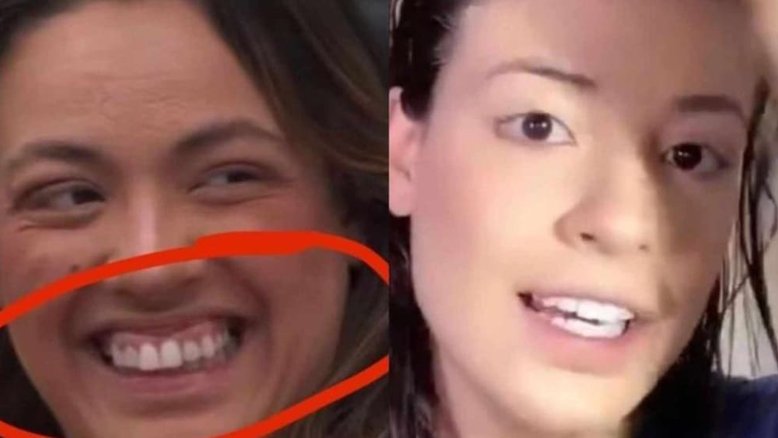 Dentistas dizem se Bia, do 'BBB24', retirou procedimento estético para entrar no reality