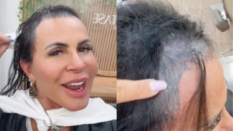 Corte químico e alopecia: médica explica problema capilar de Gretchen após cantora perder fios