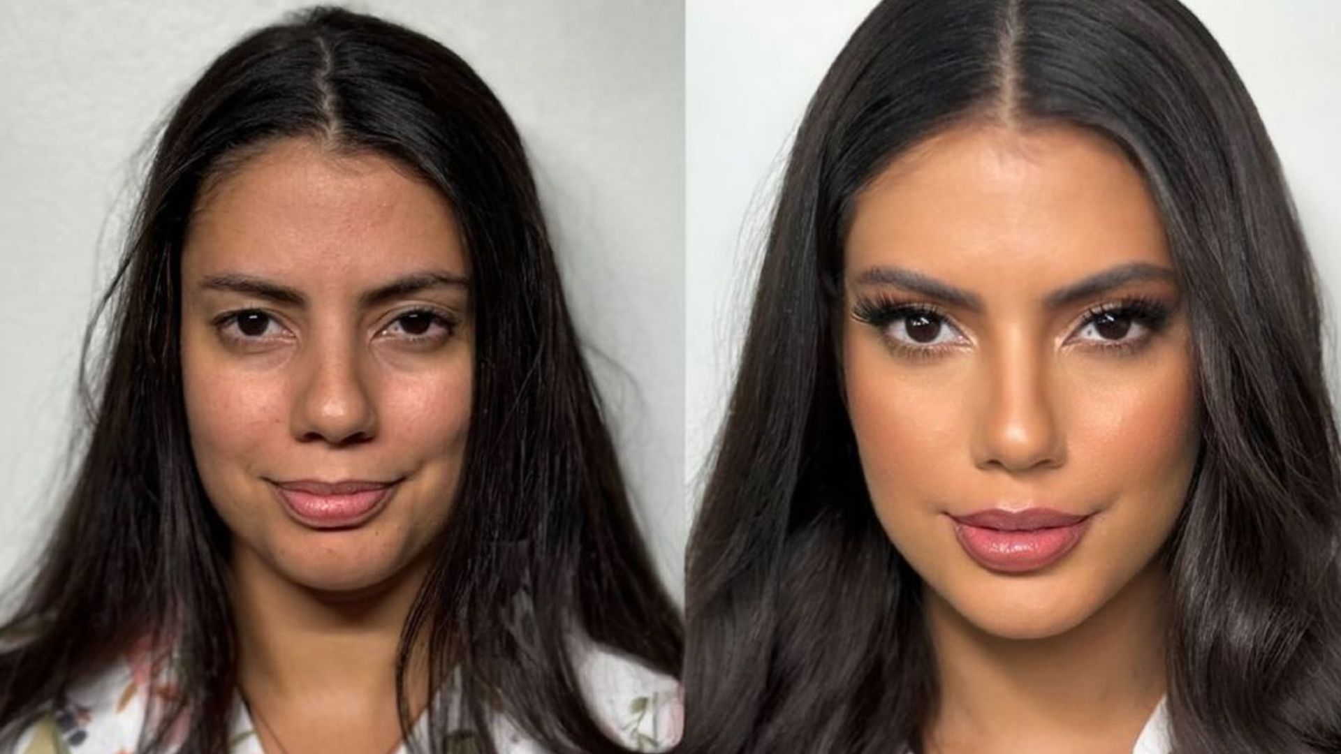 Fernanda Bande antes e depois dos procedimentos estéticos