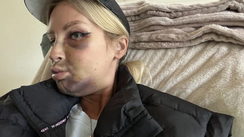 Mulher tem hematomas brutais após fixar implantes dentários
