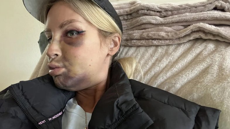 Mulher tem hematomas brutais após fixar implantes dentários