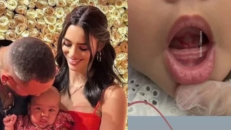 Frenectomia: médico explica cirurgia reparatória da filha de Neymar aos 6 meses de vida