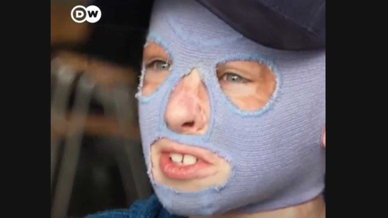 Menino ucraniano de 8 anos luta para sobreviver após ter sido atingido por mísseis russos