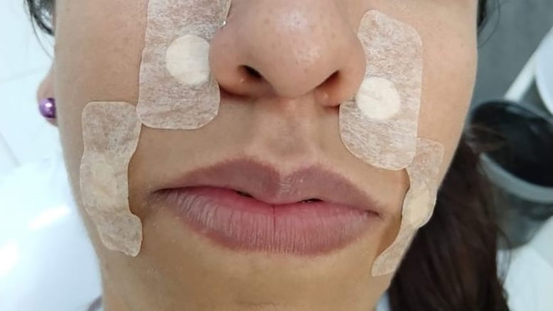 Acupuntura com silício no tratamento odontológico