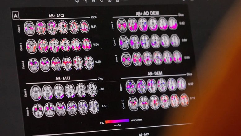 Precisão dos exames de sangue para doença de Alzheimer varia, diz estudo