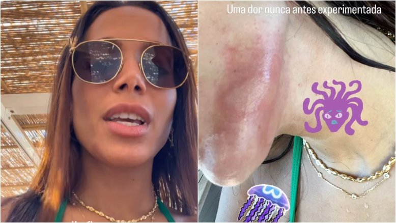 Anitta sofre queimadura por água-viva e diz ter sentido 'maior dor da vida': 'Experiência de ser eletrocutada’