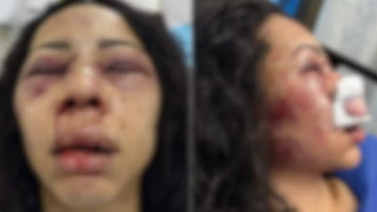 Turista brasileira é internada em estado grave após ser espancada durante assalto no Chile