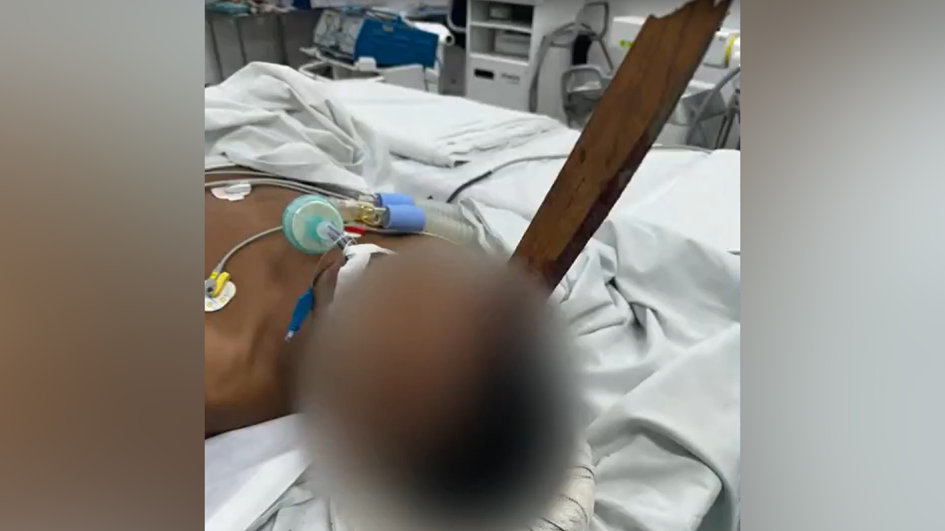 RJ: homem tem estaca de madeira cravada no crânio e sobrevive