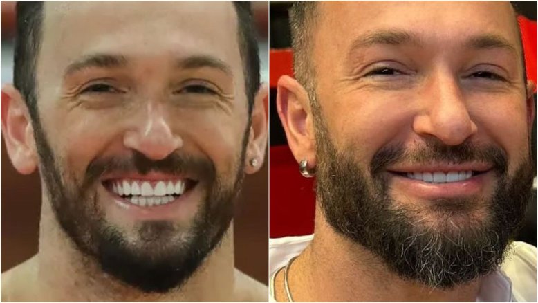 Diego Hypolito exibe mudanças no rosto e web compara: 'Hugh Jackman?'