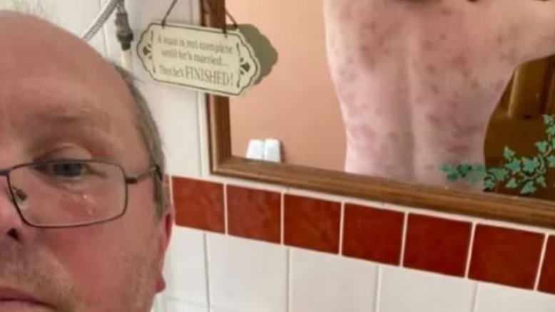 Homem é atacado por enxame de vespas e leva 240 picadas em um minuto