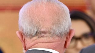 Ferimento na cabeça de Lula