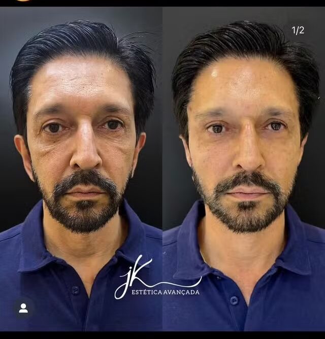 Clínica publica 'antes e depois' de harmonização facial de Ricardo Nunes, mas apaga post; veja