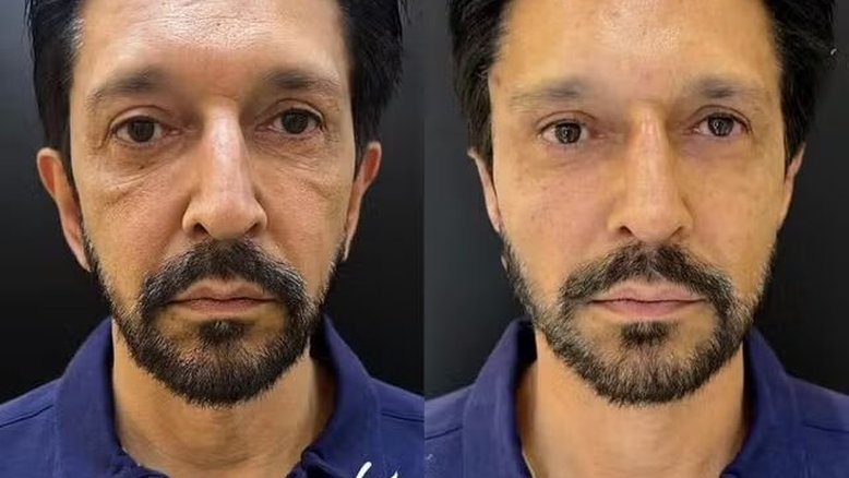 Clínica publica 'antes e depois' de harmonização facial de Ricardo Nunes, mas apaga post; veja