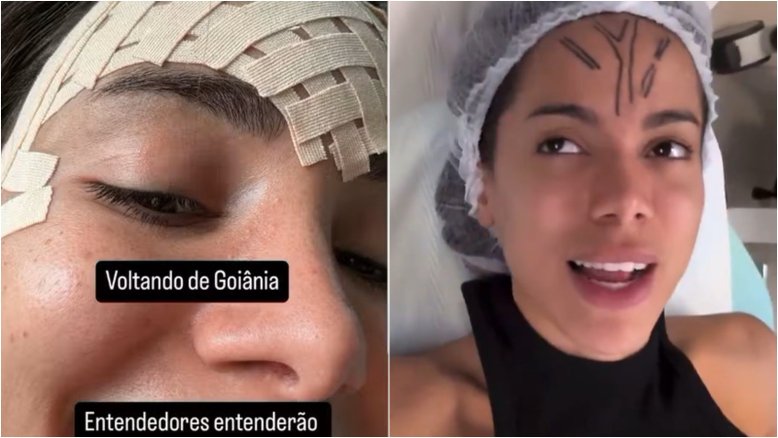 Anitta mostra curativo na testa e diz ter feito remoção de veia: ‘É só um laser, não é cirurgia’