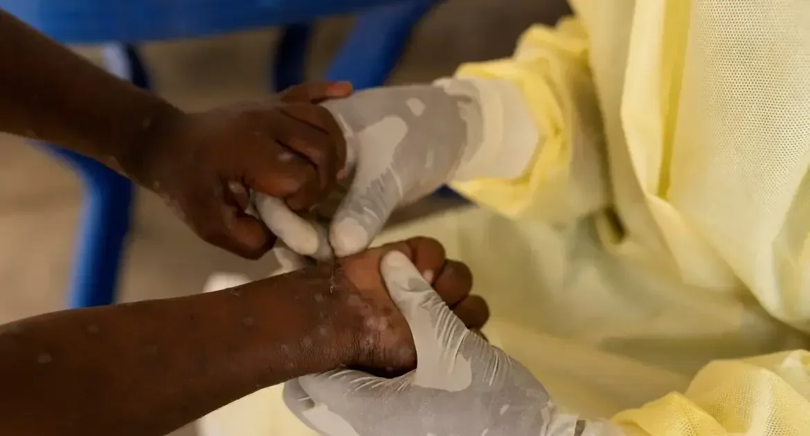 São Paulo Reports First Case of Monkeypox - News Directory 3