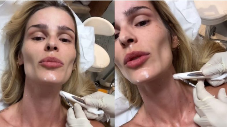 Procedimento estético Yasmin Brunet