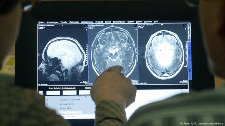 UE aprova novo tratamento contra o Alzheimer