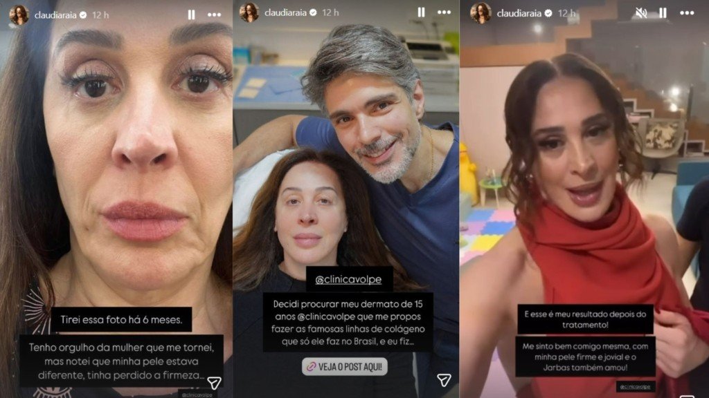 Claudia Raia exibe resultado de procedimento estético e recebe elogio do marido 2 Stories de Claudia Raia