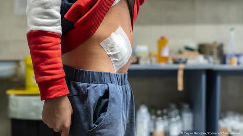 Aumento de câncer de apêndice entre jovens preocupa cientistas