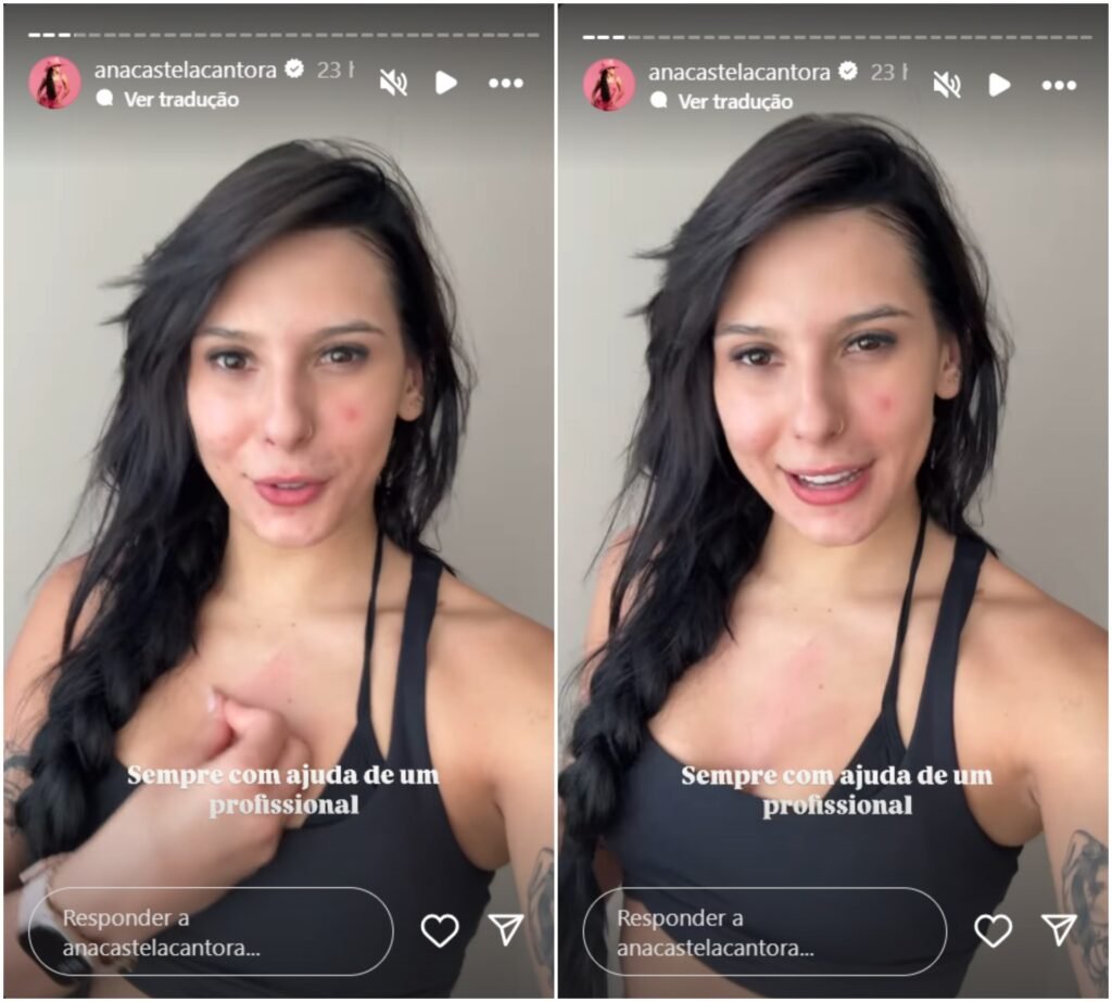 Ana Castela abre o jogo sobre acne e diz que mudou de vida; veja o que ela disse 2 Ana Castela abre o jogo sobre acne e diz que mudou de vida; veja o que ela disse