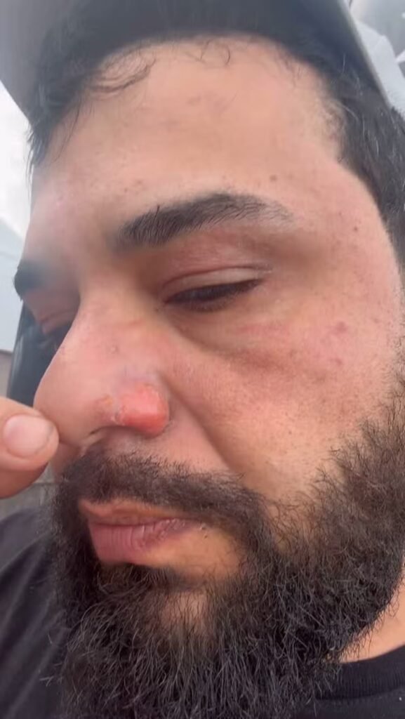 Veja como ficou rosto de sertanejo Léo após ser atingido por chamas no palco